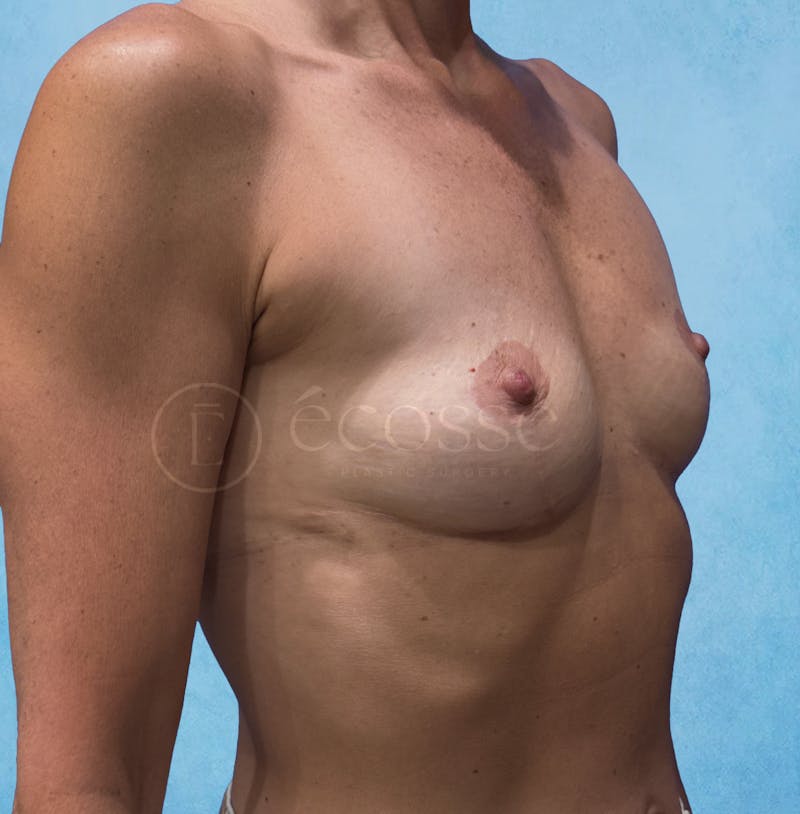 Breast Augmentation Before & After Gallery - Patient 323105 - Image 3