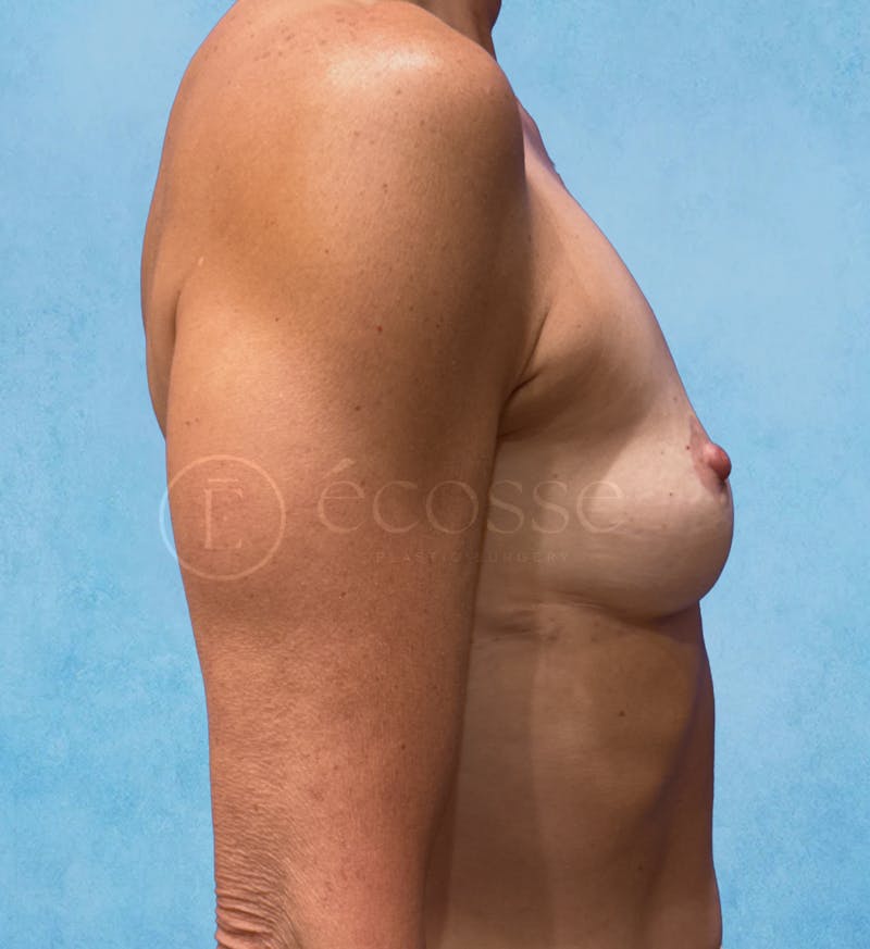 Breast Augmentation Before & After Gallery - Patient 323105 - Image 5