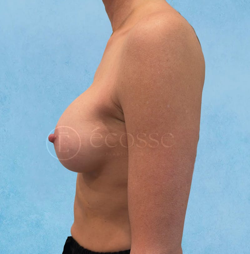 Breast Augmentation Before & After Gallery - Patient 946897 - Image 6