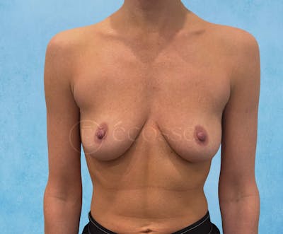 Breast Augmentation Before & After Gallery - Patient 946897 - Image 1