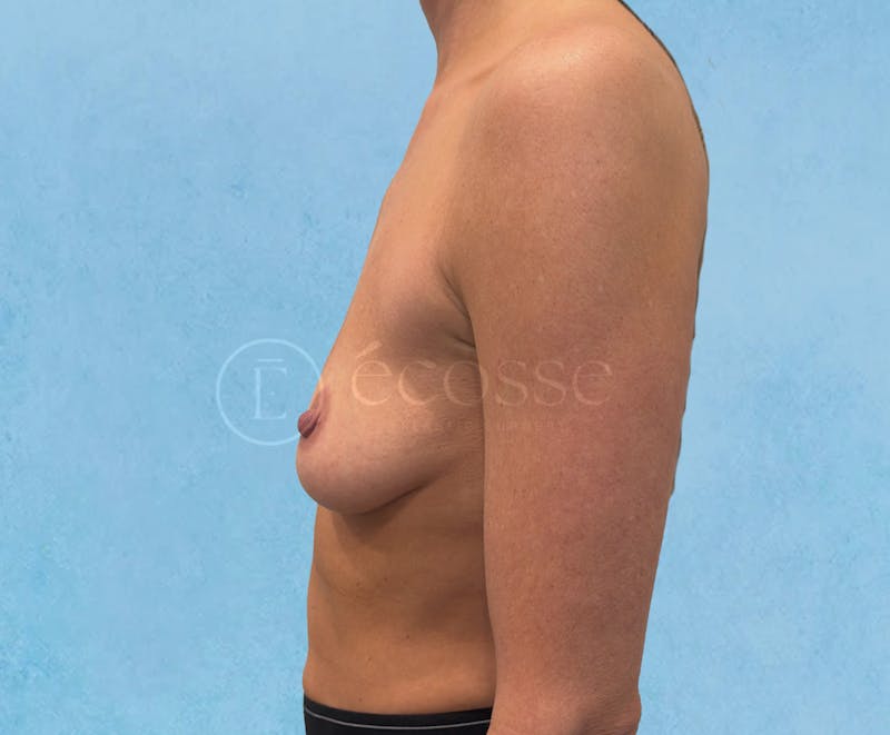 Breast Augmentation Before & After Gallery - Patient 946897 - Image 5