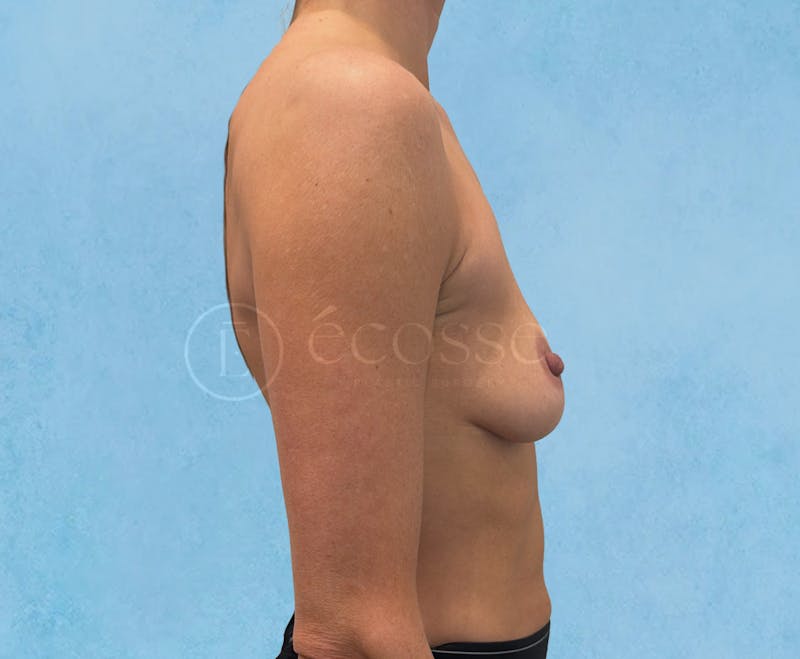 Breast Augmentation Before & After Gallery - Patient 946897 - Image 3