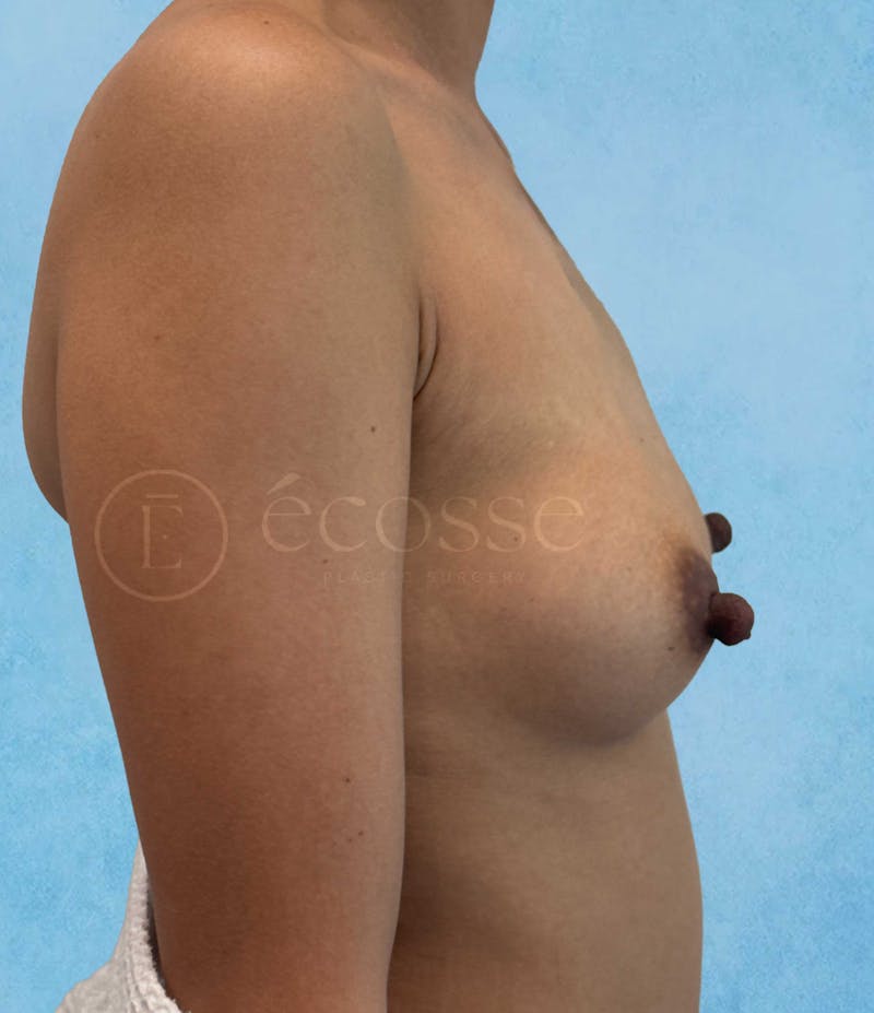 Breast Augmentation Before & After Gallery - Patient 410372 - Image 5