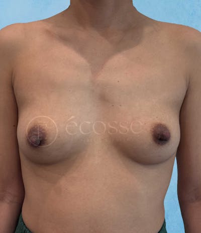 Breast Augmentation Before & After Gallery - Patient 410372 - Image 1