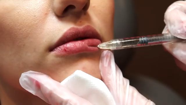 Woman getting Juvederm injections