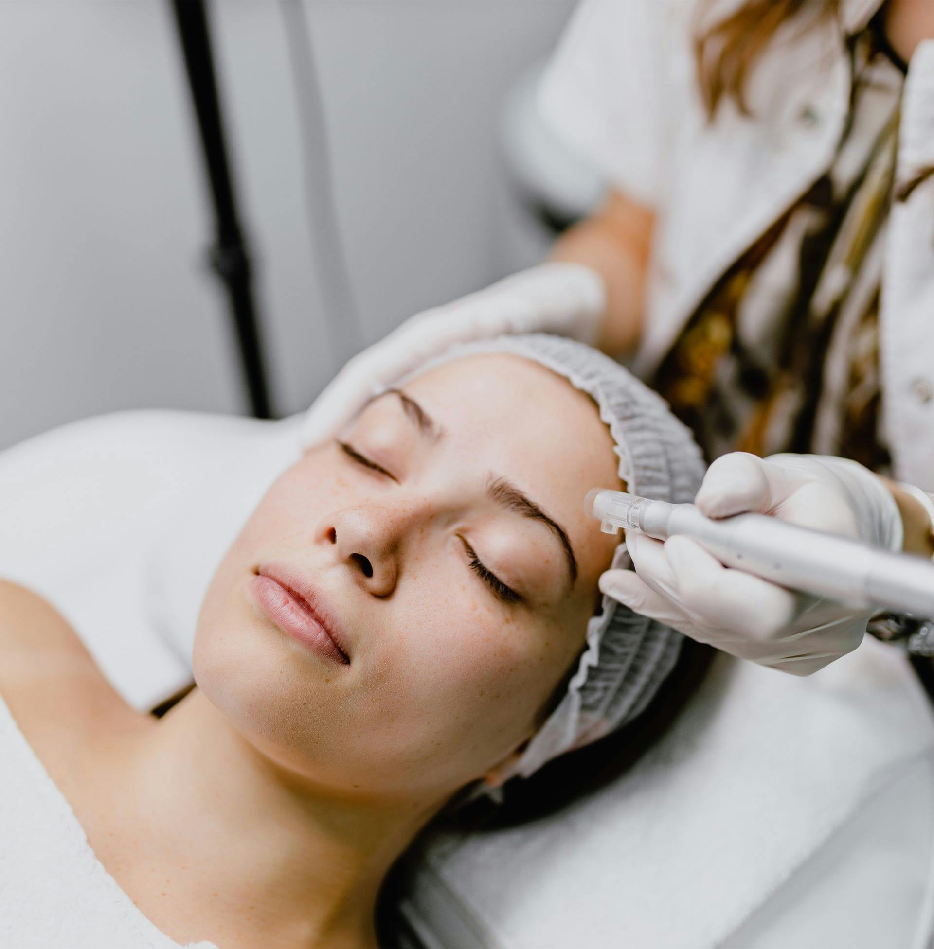 client getting microneedling procedure done on forehead