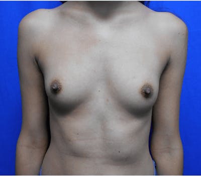 Breast Augmentation Before & After Gallery - Patient 245777 - Image 1