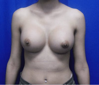 Breast Augmentation Before & After Gallery - Patient 245777 - Image 2