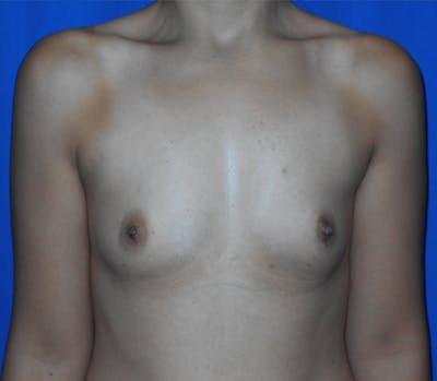 Breast Augmentation Before & After Gallery - Patient 374451 - Image 1