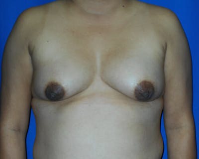 Breast Augmentation Before & After Gallery - Patient 894629 - Image 1