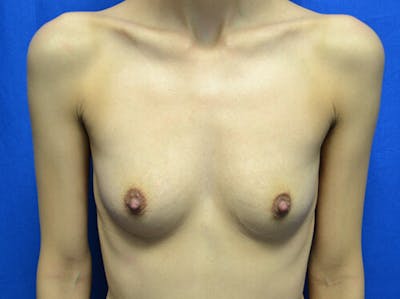 Breast Augmentation Before & After Gallery - Patient 224926 - Image 1