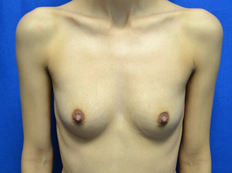 Breast Augmentation Before & After Gallery - Patient 224926 - Image 1