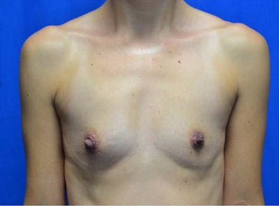 Breast Augmentation Before & After Gallery - Patient 213547 - Image 1