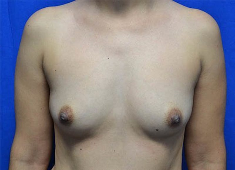Breast Augmentation Before & After Gallery - Patient 887087 - Image 1
