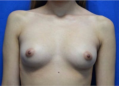 Breast Augmentation Before & After Gallery - Patient 600564 - Image 1