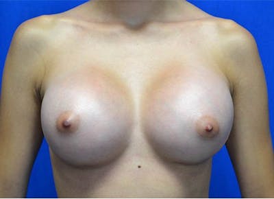 Breast Augmentation Before & After Gallery - Patient 600564 - Image 2