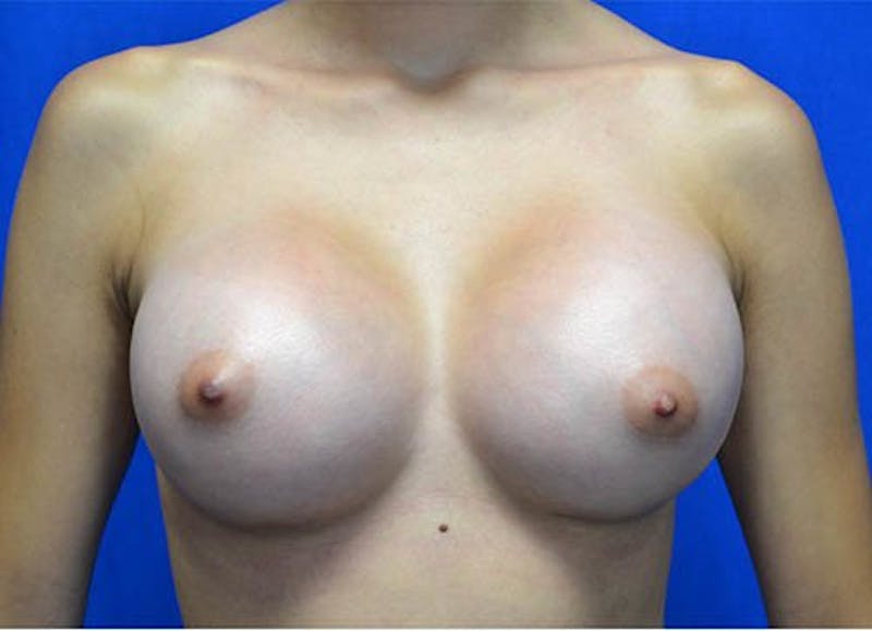Breast Augmentation Before & After Gallery - Patient 600564 - Image 2