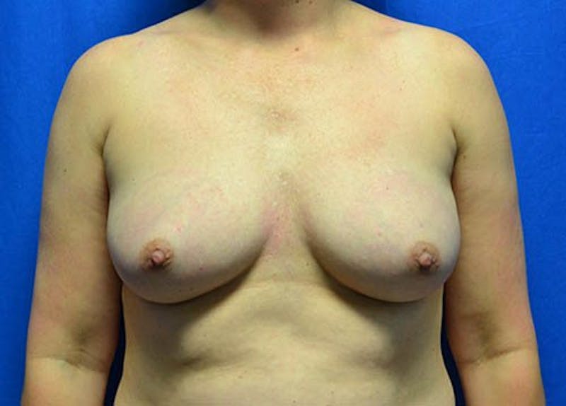 Breast Augmentation Before & After Gallery - Patient 273693 - Image 1