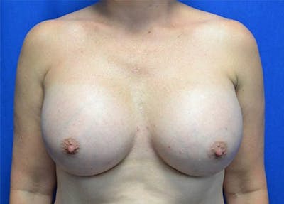 Breast Augmentation Before & After Gallery - Patient 273693 - Image 2