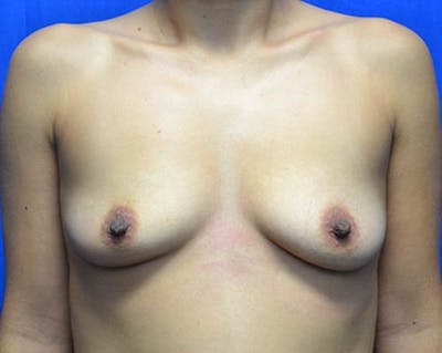 Breast Augmentation Before & After Gallery - Patient 141339 - Image 1