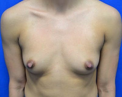 Breast Augmentation Before & After Gallery - Patient 648312 - Image 1