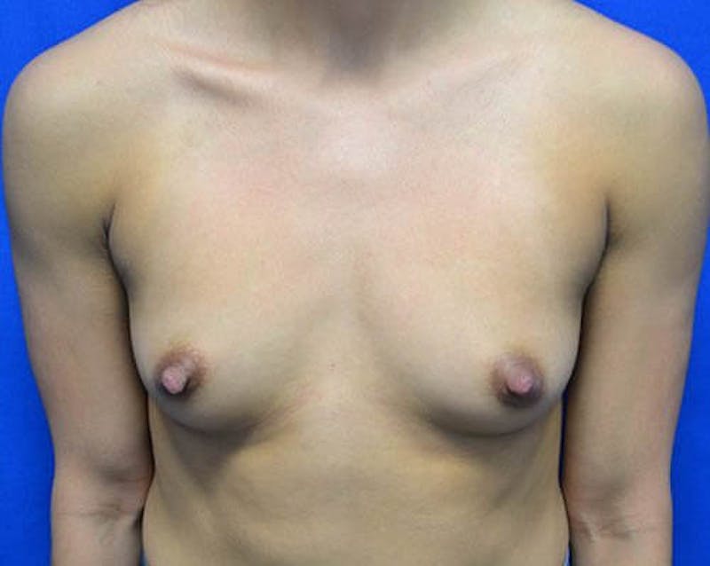 Breast Augmentation Before & After Gallery - Patient 648312 - Image 1