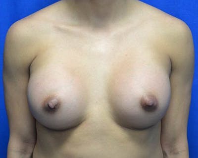 Breast Augmentation Before & After Gallery - Patient 648312 - Image 2