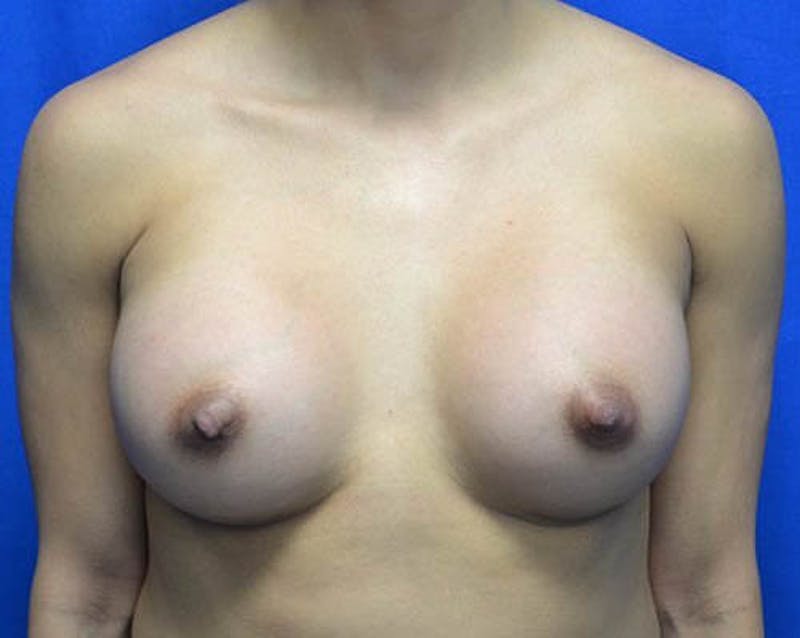 Breast Augmentation Before & After Gallery - Patient 648312 - Image 2