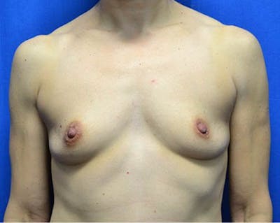 Breast Augmentation Before & After Gallery - Patient 995881 - Image 1