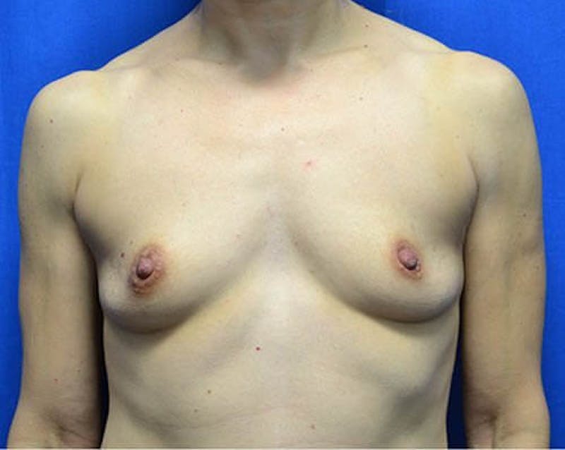 Breast Augmentation Before & After Gallery - Patient 995881 - Image 1