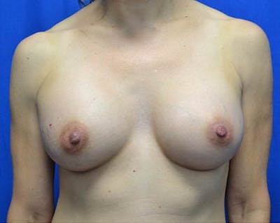 Breast Augmentation Before & After Gallery - Patient 995881 - Image 2
