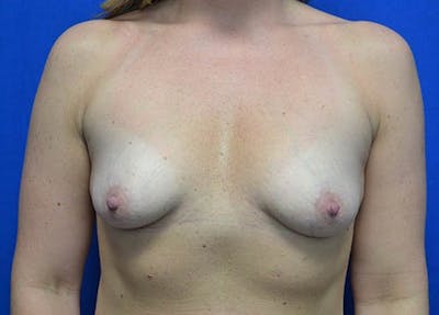 Breast Augmentation Before & After Gallery - Patient 179898 - Image 1
