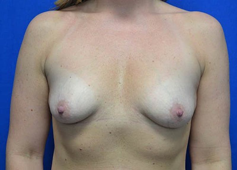 Breast Augmentation Before & After Gallery - Patient 179898 - Image 1