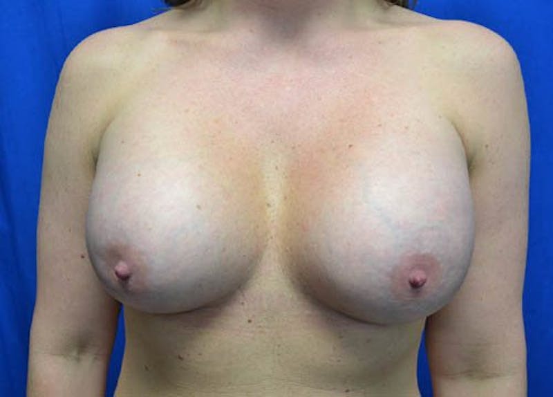 Breast Augmentation Before & After Gallery - Patient 179898 - Image 2