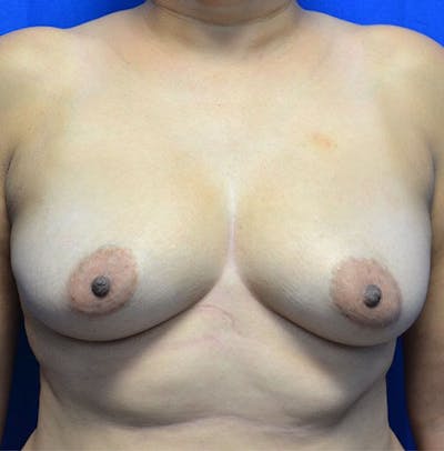 Breast Augmentation Before & After Gallery - Patient 154827 - Image 1