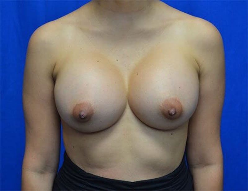 Breast Augmentation Before & After Gallery - Patient 281337 - Image 2