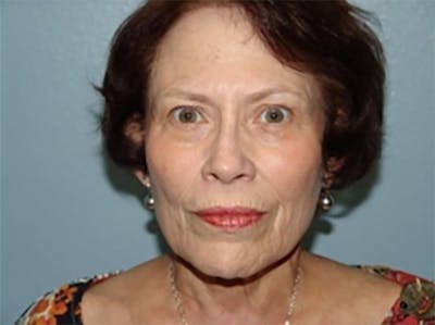 Combo Procedures - Face Before & After Gallery - Patient 175865 - Image 1