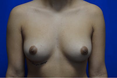 Breast Augmentation Before & After Gallery - Patient 222127 - Image 1