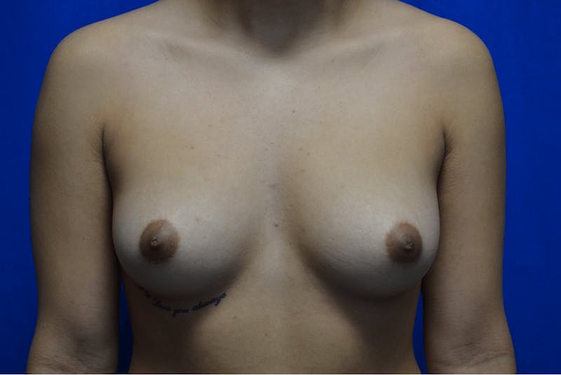 Breast Augmentation Before & After Gallery - Patient 222127 - Image 1