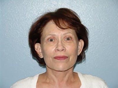 Combo Procedures - Face Before & After Gallery - Patient 175865 - Image 2