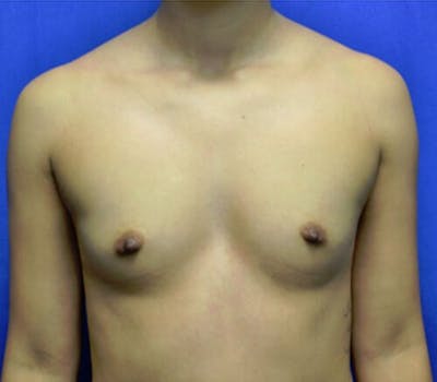 Breast Augmentation Before & After Gallery - Patient 509374 - Image 1