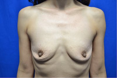 Breast Augmentation Before & After Gallery - Patient 355661 - Image 1