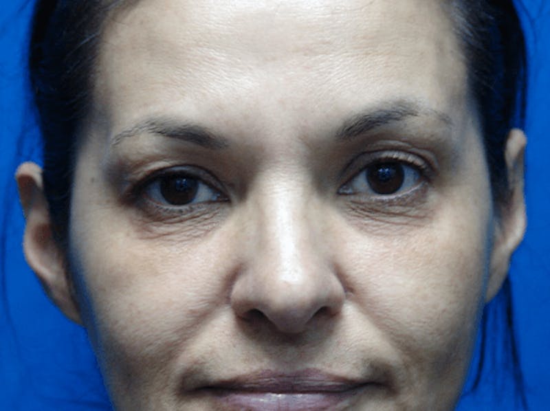 Eyelid Lift Before & After Gallery - Patient 120166 - Image 1