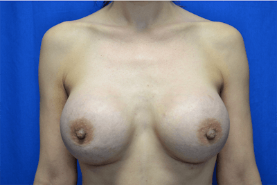 Breast Augmentation Before & After Gallery - Patient 355661 - Image 2