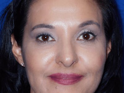Eyelid Lift Before & After Gallery - Patient 120166 - Image 2