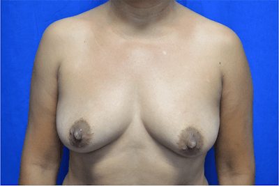 Breast Augmentation Before & After Gallery - Patient 224348 - Image 1