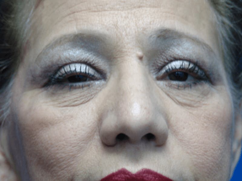 Eyelid Lift Before & After Gallery - Patient 330330 - Image 1