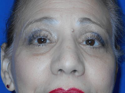 Eyelid Lift Before & After Gallery - Patient 330330 - Image 2