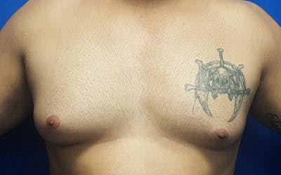 Gynecomastia Before & After Gallery - Patient 187372 - Image 1