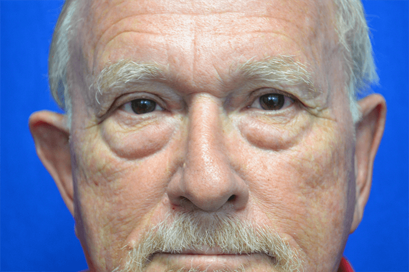 Eyelid Lift Before & After Gallery - Patient 291690 - Image 1